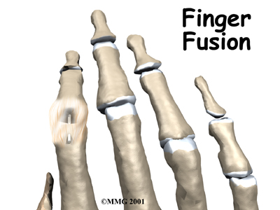 Finger Fusion Surgery - One Wellness Guide
