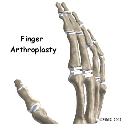 Artificial Joint Replacement of the Finger - One Wellness Guide