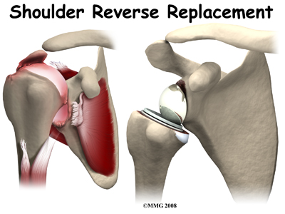 Reverse Shoulder Arthroplasty